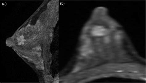 A Fibroadenoma In The Right Breast Of A 26 Year Old Woman A Sagittal