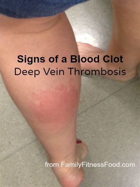 17 Best images about blood Clot's on Pinterest | Do you know what, Happenings and Lil sis