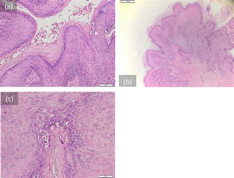 Figure 2 From A Case Of Genital And Extragenital Warts Unresponsive To