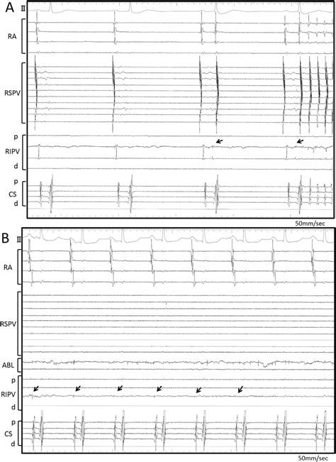 A Intracardiac Electrograms At The Initiation Of Atrial Fibrillation