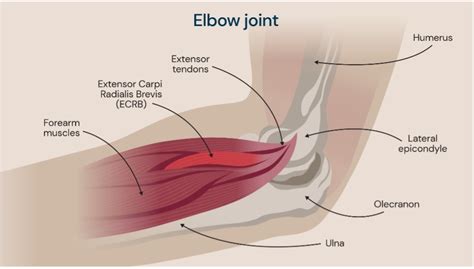 Tennis Elbow What Is It And How Do You Fix It
