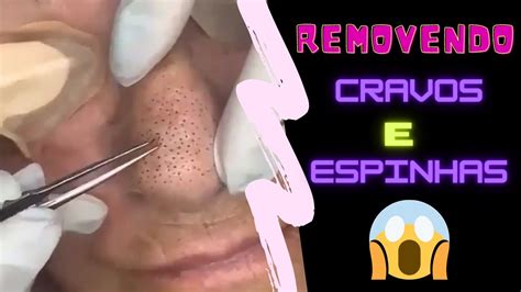 Extração De Cravos E Espinhas Gigantes - Removendo cravos e espinhas gigantes do rosto - YouTube