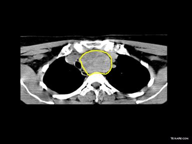 Mediastinal mass differential diagnosis - wikidoc