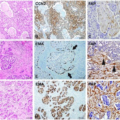 Connective Tissue Growth Factor Ccn Epithelial Membrane Antigen