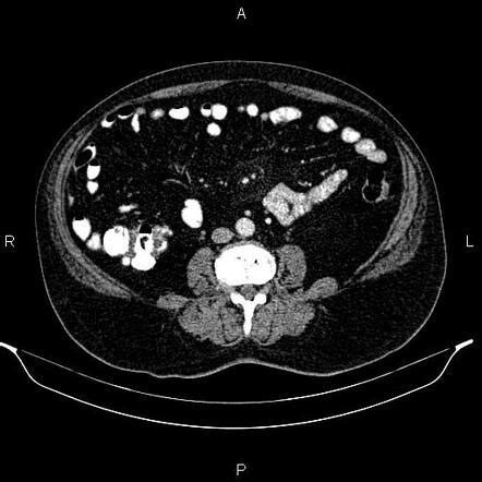 Colocolic Intussusception Due To The Tumoral Infiltration Image