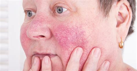 10 Treatments For Rosacea Facty Health