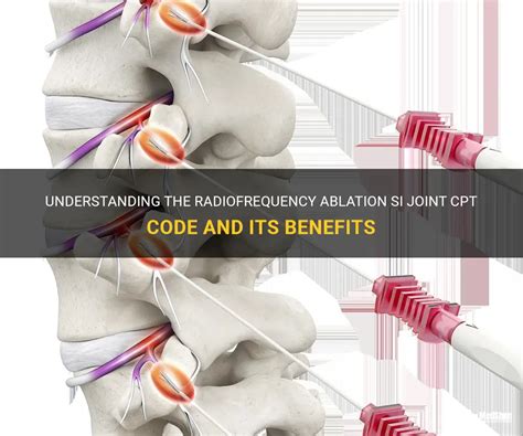 Understanding The Radiofrequency Ablation Si Joint Cpt Code And Its