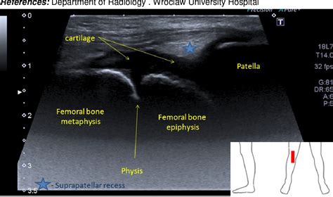 Lateral Knee Anatomy Ultrasound