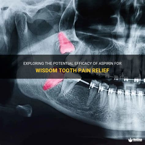 Exploring The Potential Efficacy Of Aspirin For Wisdom Tooth Pain