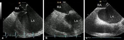 A Series Of Three Ice Images Obtained During Transseptal Puncture Ra