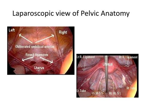 Pelvic Anatomy Laparoscopy - laparoscopic hysterectomy Carcinoma ...