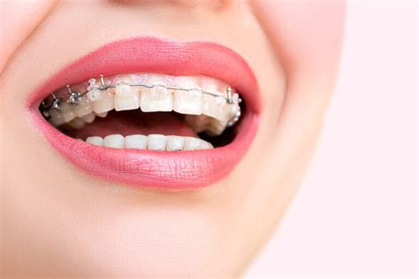 Aparat Dentar Ceramic Avantaje Preturi Si Imagini Operadental