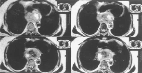 Figure 1 From Surgical Treatment Of Giant Esophageal Leiomyoma Semantic Scholar