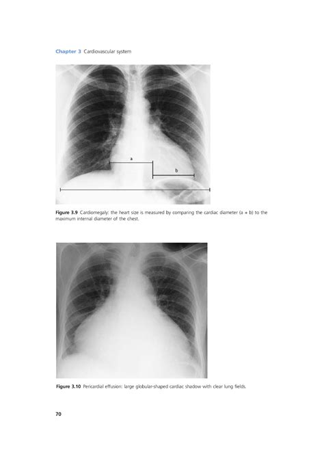 Cardiomegaly Measurement