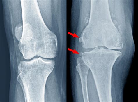 Osteoarthritis knee . film x-ray 15763177 Stock Photo at Vecteezy