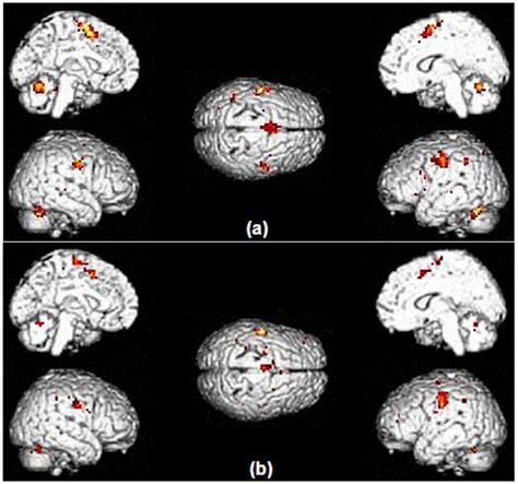 Patterns Of Brain Activation During The Speech Production Task In PD