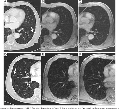 Lung Cancer Mri