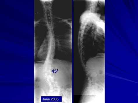 Case Review 5 43 Year Old Woman With Adult Idiopathic Scoliosis Ppt