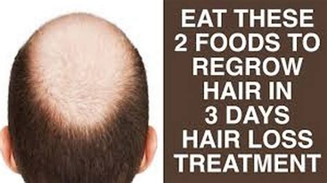 Eat These 2 Foods To Regrow Hair In 3 Days Hair Loss Treatment Hair Loss Cure Youtube