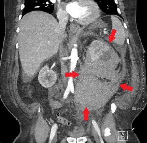 Retroperitoneal Bleed