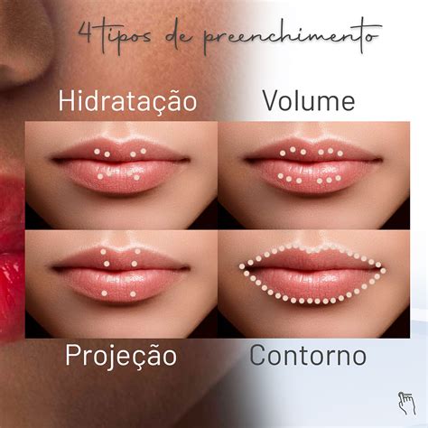 Saiba Qual O Tipo De Preenchimento Labial Ideal Para Você