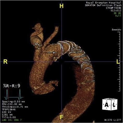 Postoperative 3d Reconstruction Following Deployment Of The Stented Download Scientific Diagram