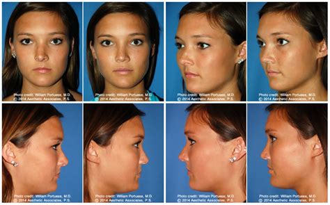 Crooked Nasal Bones Before And After Photo Gallery Nose Surgery Photos