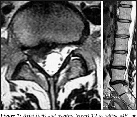 Figure 1 From Spontaneous Regression Of Extruded Lumbar Disc Herniation