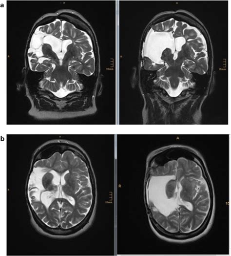 Functional Hemispherectomy Is Safe And Effective In Adult Patients With