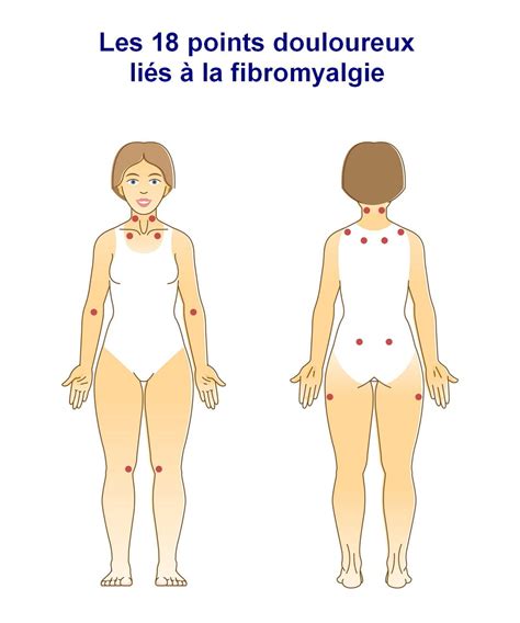 Fibromyalgie symptômes comment calmer une crise