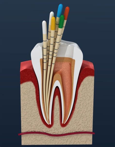 Root Canal Sealers Dr Fay Mansouri