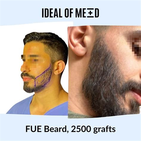 Beard Transplant In Turkey Expectations Methods And More