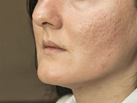 Woman With Problematic Skin And Acne Scars Pigmentation On Face Woman