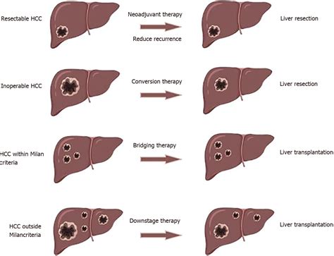 Neoadjuvant Treatment Strategies For Hepatocellular Carcinoma