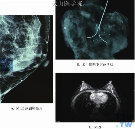 附图乳腺导管原位癌钼靶摄片及MRI表现 乳腺肿瘤学 天山医学院