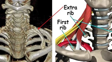 CERVICAL RIB: Extra Rib in Neck - Physiotherapy Treatment