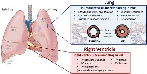 Pathogenesis Of Pulmonary Hypertension Pah Is Associated With Vascular