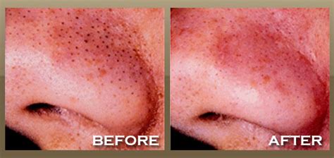 Microdermabrasion Skinpeccable