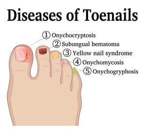 Toe Pain And Discolored toenails