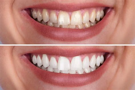 Tooth Discoloration What Causes It And How To Prevent It Healthtian