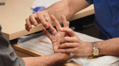 understanding dupuytrens contracture  center