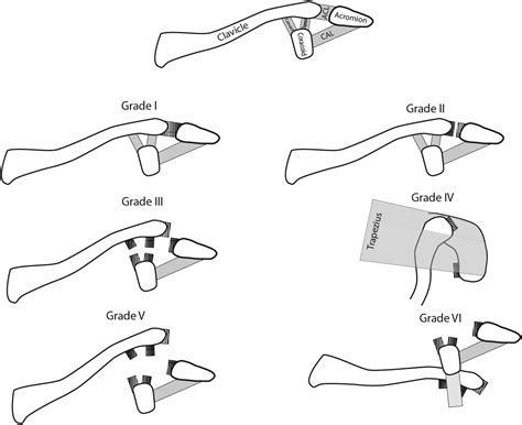 Injuries Of The Acromioclavicular Joint Orthopaedics And Trauma