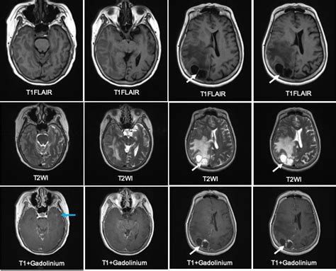 Cystic Cerebral Metastasis Radiology Cases