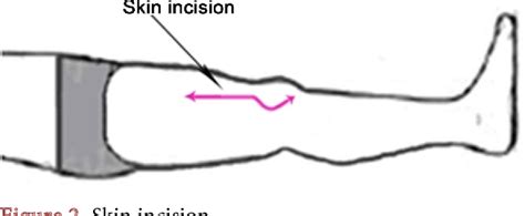 Figure 2 From The Iliotibial Band Transfer Restores Extensor Function