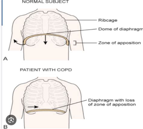 Eocp Block Copd Flashcards Quizlet