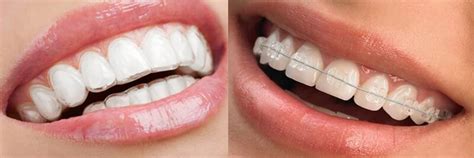 Compare Invisalign vs Braces treatment in Cornelius, Huntersville, Davidson NC - Lake Norman ...