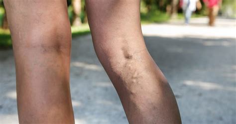 Varicose Veins Causes Symptoms And Treatment Options Top Varicose