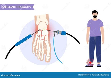 Ankle Arthroscopy Poster Stock Vector Illustration Of Camera 282550375