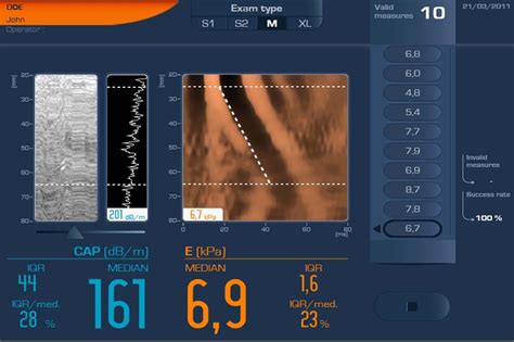 Купить Echosens Fibroscan 502 Touch Цена 11 250 000р УЗИ аппараты в