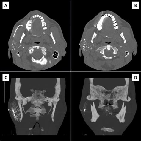 Parotid Gland Swelling Differential Diagnosis